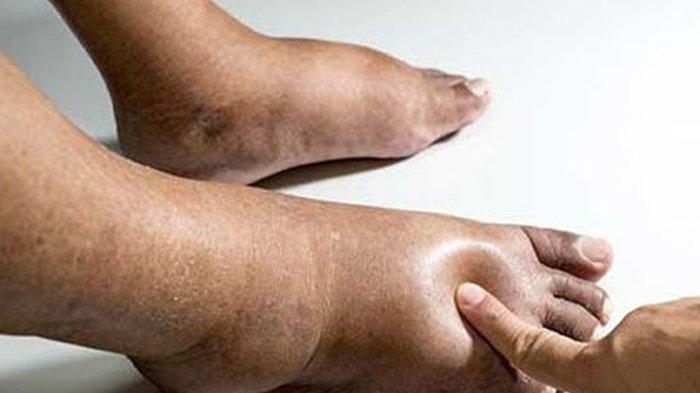 Kaki Bengkak Gejala Jantung Bermasalah? Kenali Ciri-Ciri Kaki Bengkak