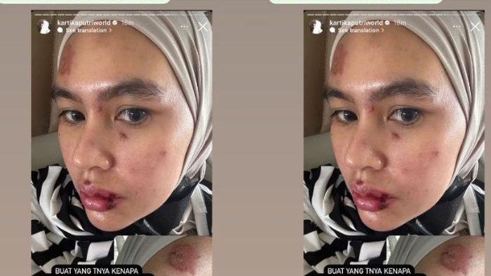 Kartika Putri Dikaitkan Dengan Terkena Karma, Netizen Sebut Kena