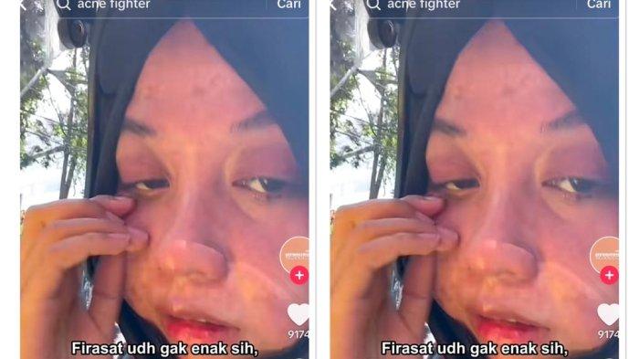 Detik-detik curhatan pilu seorang wanita soal kisah pedihnya ditolak HRD saat wawancara kerja gara-gara jerawat viral di media sosial. 