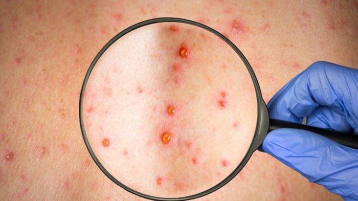 Ilustrasi penyakit Monkeypox