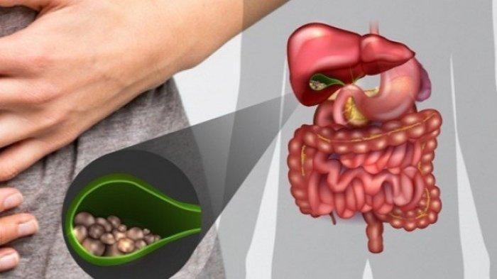 Batu empedu adalah benda keras menyerupai batu yang tumbuh di kantong atau saluran empedu. Sebagai informasi, kantong empedu adalah kantong kecil yang terletak di sisi kanan tubuh, tepatnya di bagian bawah organ hati atau liver.