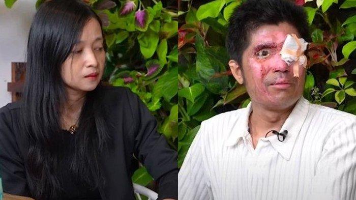 Agus Korban Penyiraman Air Keras