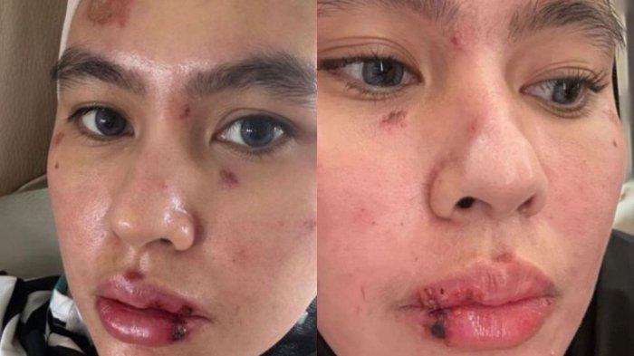 Kartika Putri kena Autoimun