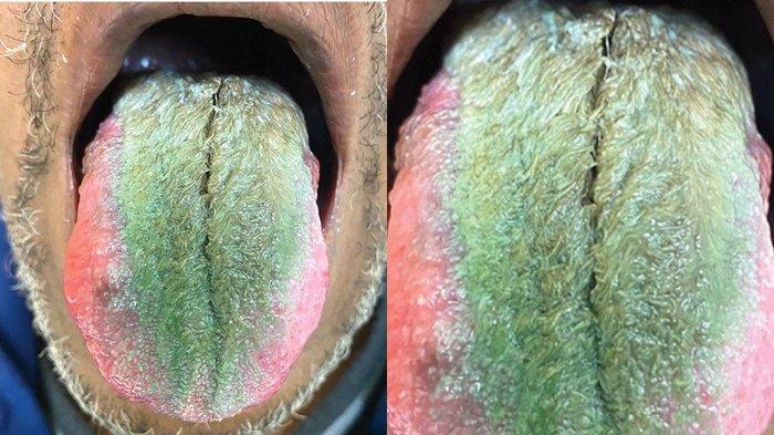 Penampakkan lidah perokok yang muncul bulu hijau di lidahnya. (IndiaTimes)