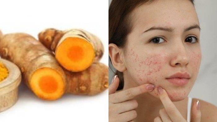 Cara mengobati jerawat dengan kunyit