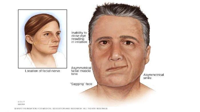 Bell's Palsy.