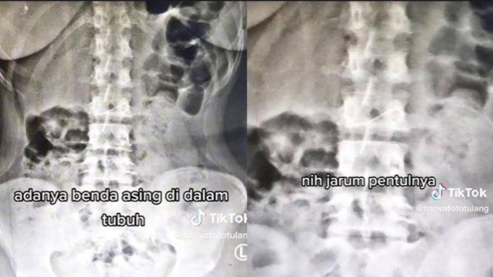 Viral di media sosial hijaber tertelan jarum pentul hingga nyangkut di usus.