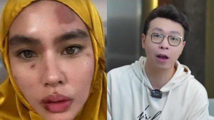 Kartika Putri mengalami masalah kulit hingga harus berobat ke Singapura. Pada sebuah foto yang beredar, wajah Kartika Putri lebam. 
