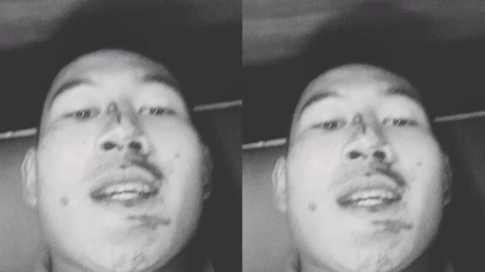 Kondisi kapten tim sepakbola putra Sumut, Alif Eka Rizky usai di keroyok tim Papua Barat di dalam hotel Medan, Banda Aceh, Rabu (11/9/2024) malam.