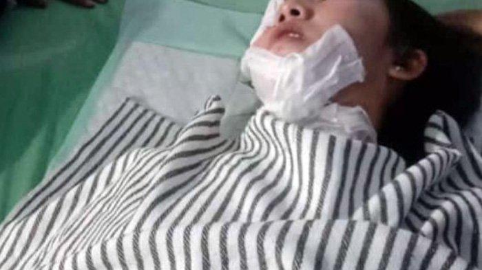 Mama muda bernama Farah Rizka (20) di Bekasi Utara, jadi korban penyiraman air keras oleh pelaku diduga teman dekatnya bernama Johan (23). (Istimewa)