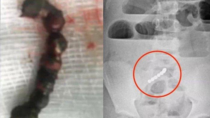 Mengeluh Sakit Perut Parah 4 Hari, Dokter Syok Temukan 7 Magnet dalam Usus Kecil Bocah Perempuan