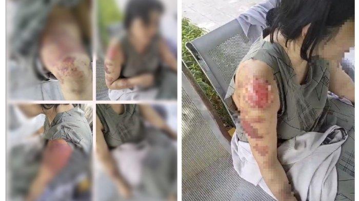 Viral di media sosial video seorang Tenaga Kerja Indonesia (TKI) perempuan asal Kabupaten Karawang, Jawa Barat, mengalami luka bakar parah di sekujur tubuhnya setelah disekap dan dianiaya sepasang suami istri orang Bangladesh dan Yaman di Arab Saudi. (Istimewa)