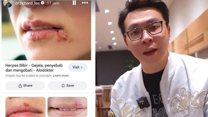 Unggah Soal Penyakit Herpes di Bibir, Richard Lee Diduga Sindir Kartika Putri, Ungkit Soal Penjara