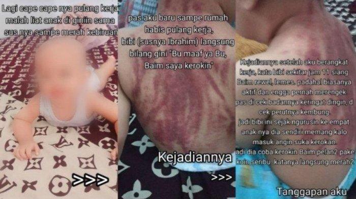 VIRAL Bayi 13 Bulan Dikerok Pengasuh hingga Kulit Merah, Dikira Masuk Angin, Ibu Maafkan Pelaku