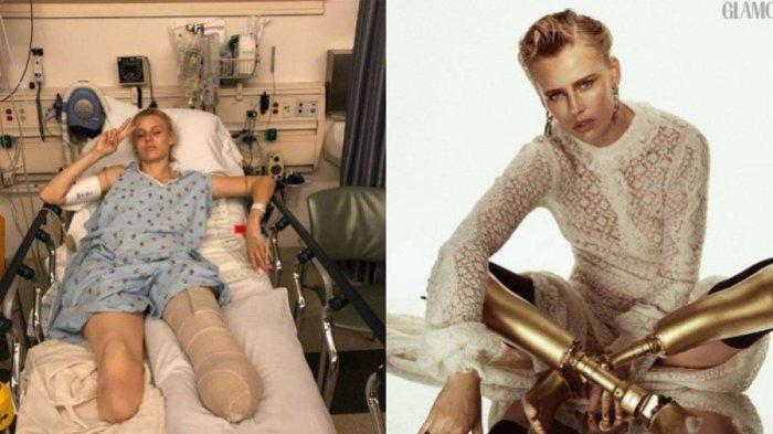 VIRAL Gara-gara Pembalut, Wanita Ini Harus Kehilangan Kakinya, Terpaksa Diamputasi Karena Infeksi