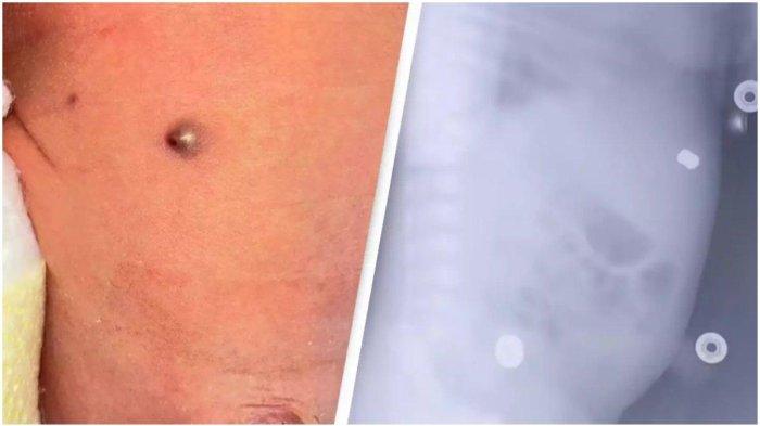 VIRAL Potret Bayi Lahir dengan Peluru di Perut, Ibu Ternyata Tertembak Ayah saat Hamil Tua