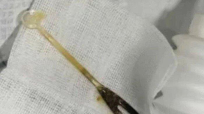VIRAL Pria Sakit Perut Luar Biasa Selama 3 Bulan, Dokter Syok Ternyata Ada Garpu di Lambungnya
