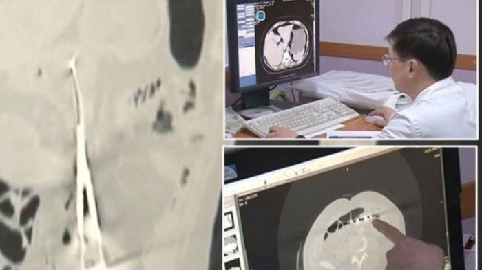 Ilustrasi hasil rontgen gunting dalam tubuh