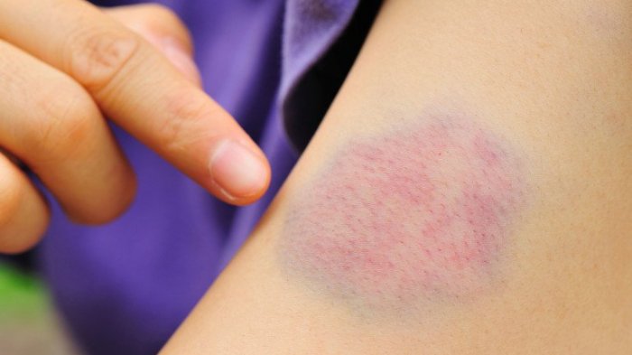 Ilustrasi memar di kulit.