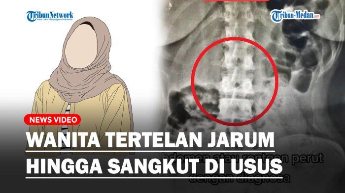 Viral seorang dokter menerima hasil rontgen dari seorang wanita yang tertelan jarum pentul, hingga sangkut di ususnya, Selasa (7/2/2023).