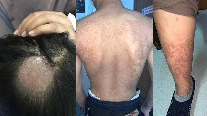 Penyakit Kulit Jamur - Tribun-medan.com