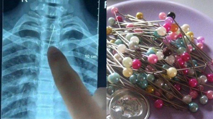 Jarum untuk memasang hijab tertelan hingga tersangkut di trakea seorang wanita