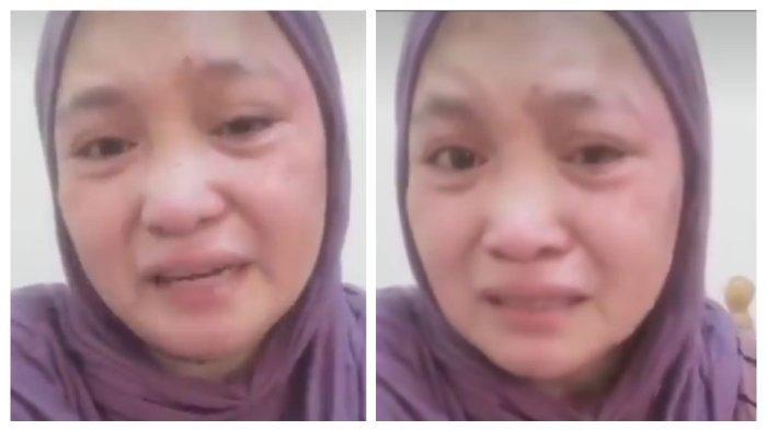 Penampakan wajah memar Nurul Huda, TKW asal Dompu usai menerima siksaan berkali-kali di Oman.