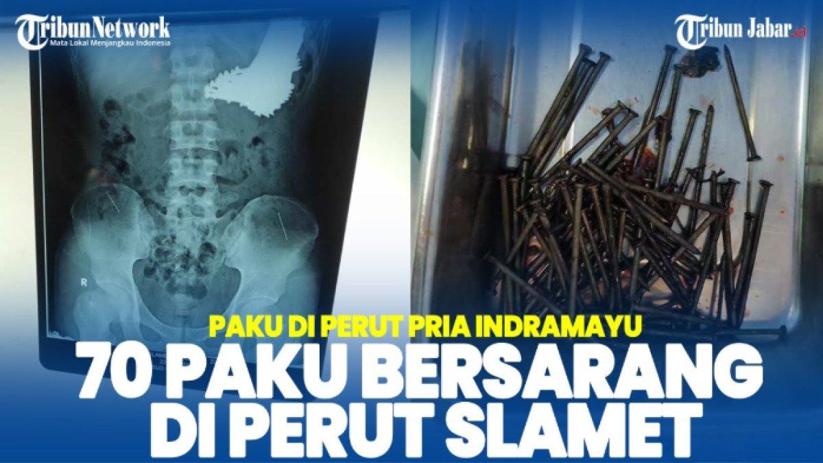 5 fakta mencengangkan kasus 70 paku yang bersarang di perut seorang pemuda di Indramayu, Jawa Barat yang diduga ODGJ & overdosis obat.