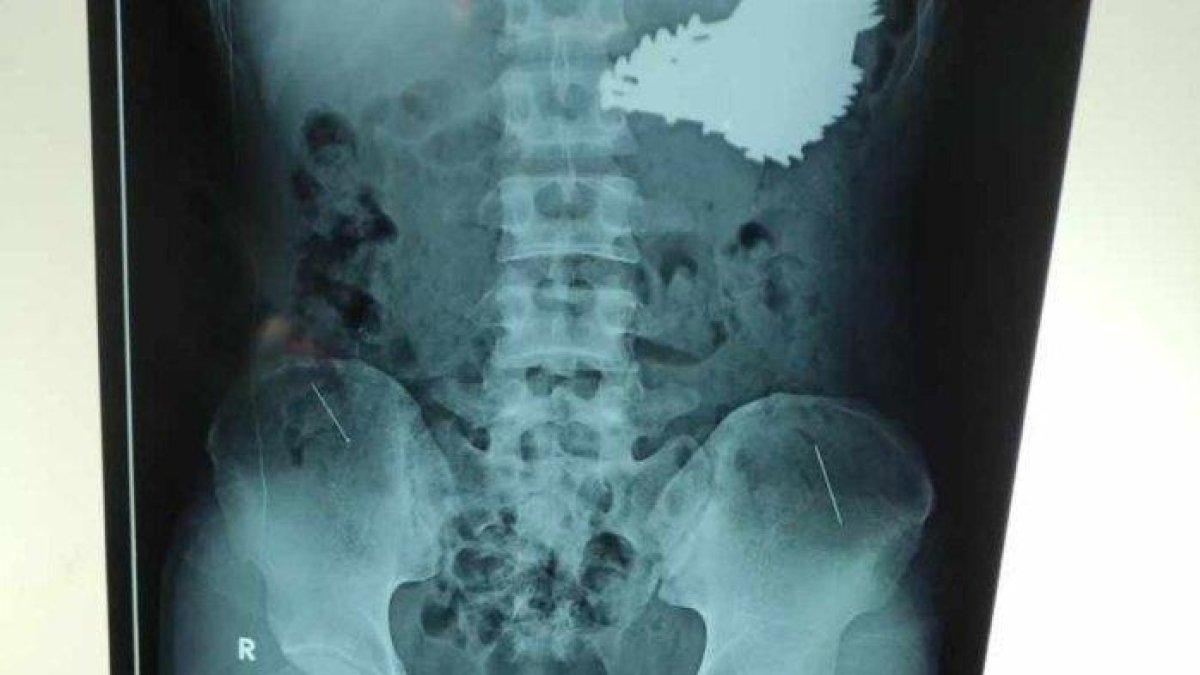 5 fakta mencengangkan kasus 70 paku yang bersarang di perut seorang pemuda di Indramayu, Jawa Barat yang diduga ODGJ & overdosis obat.