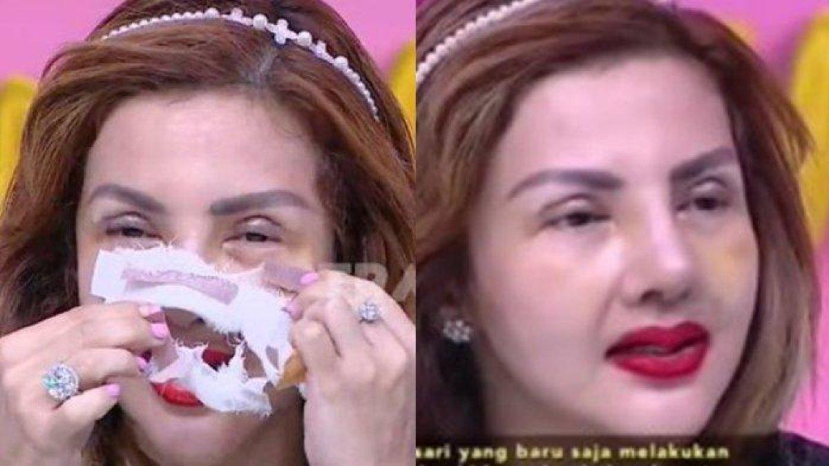 Barbie Kumalasari Jalani Operasi Hidung