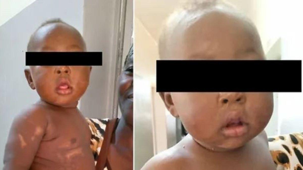Bayi dikubur hidup-hidup, secara ajaib dia tidak menderita luka apa pun di jantung, perut, atau organ lainnya.