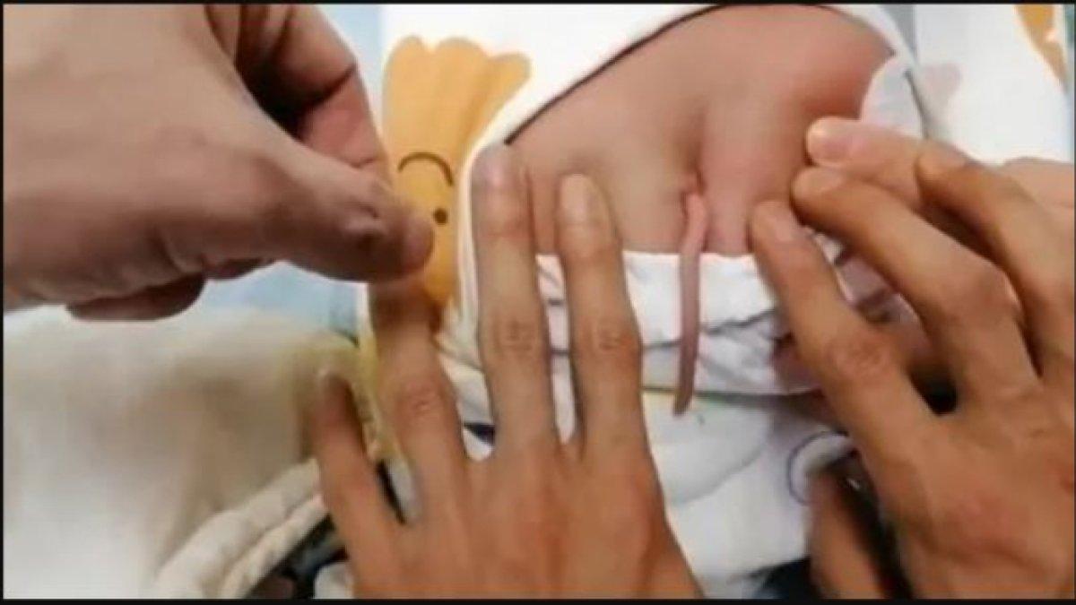 Bayi lahir memiliki ekor