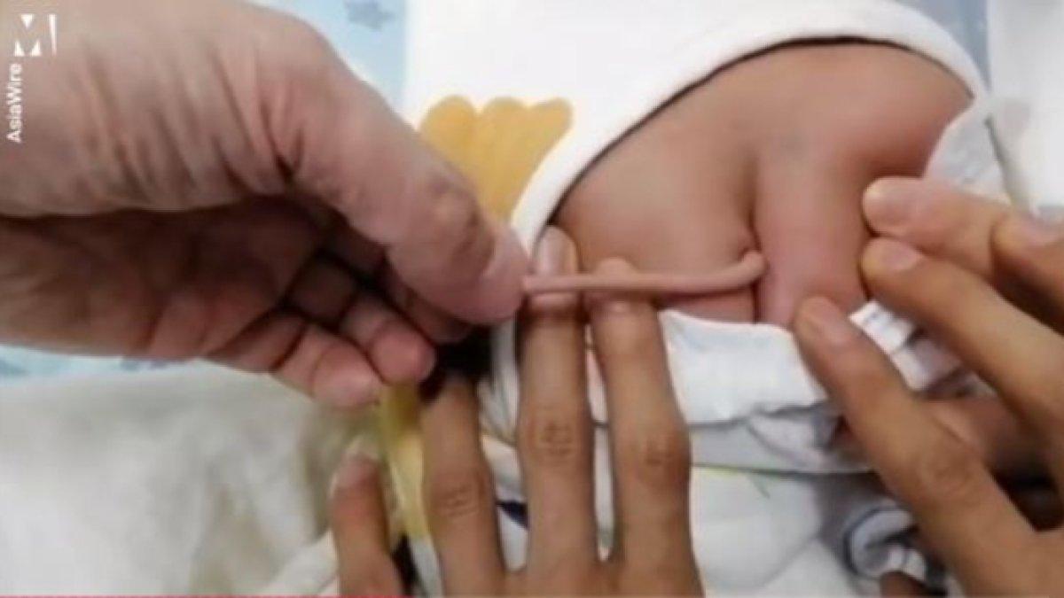 Bayi lahir memiliki ekor