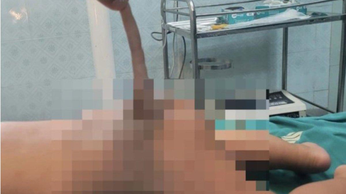 Bayi mendadak memiliki ekor 14cm, orangtua panik, kelainan langka