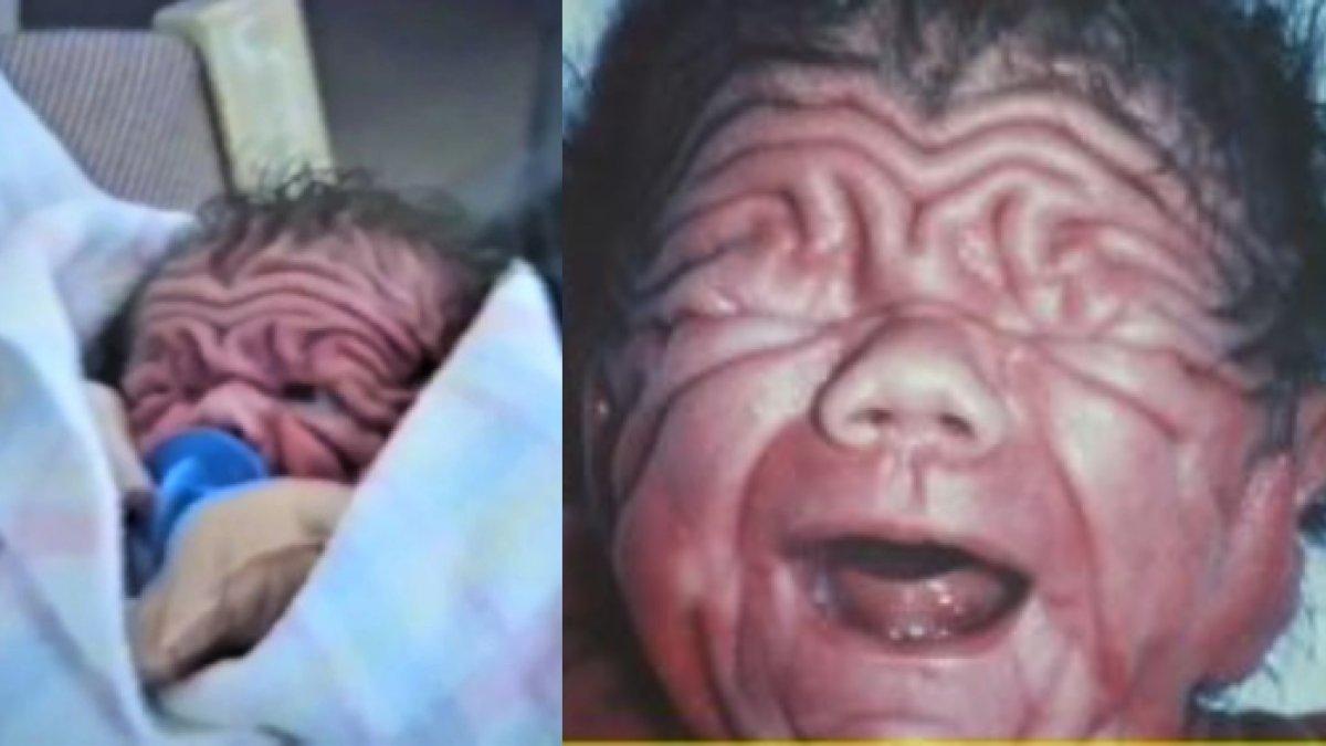 Bayi terlahir dengan kulit yang mengkerut