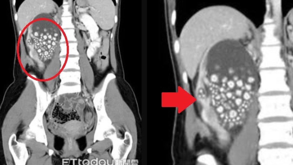 CT scan menemukan bahwa batu tersebut berukuran antara 5mm dan 2cm
