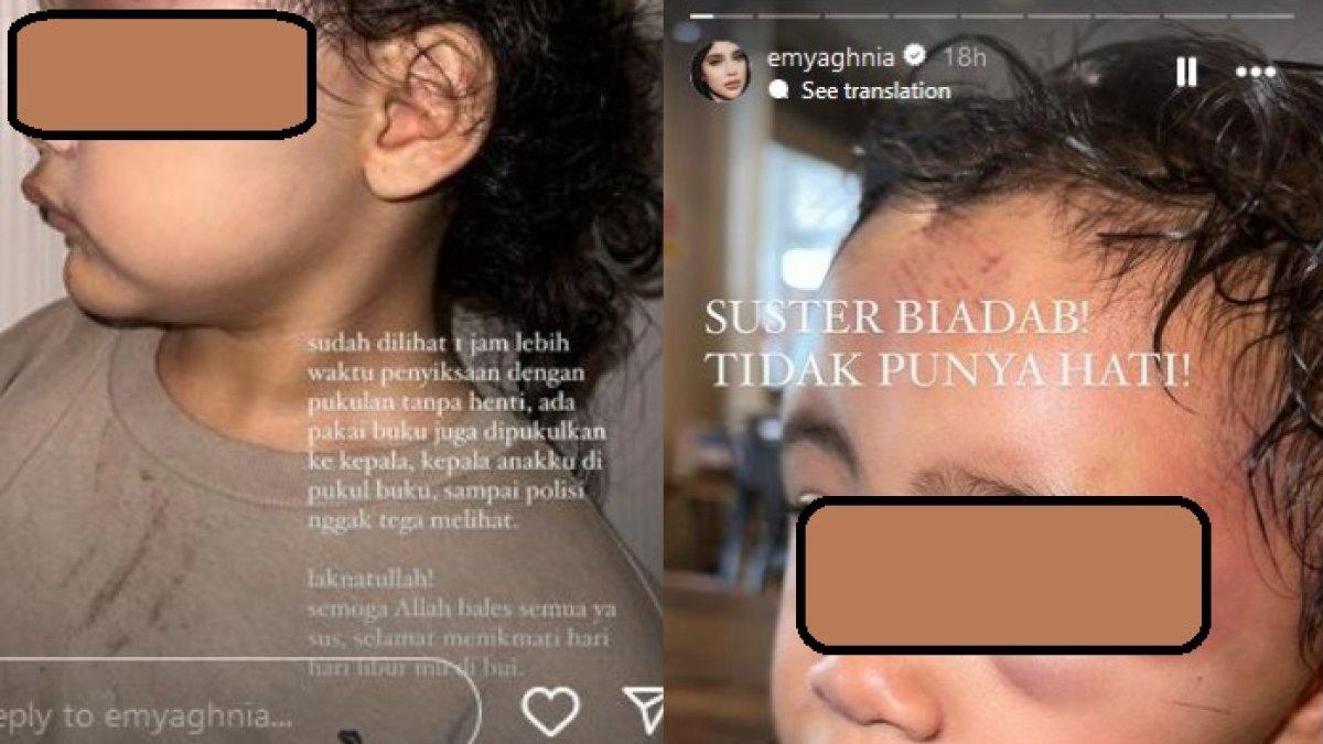 Cana anak Emy Aghnia korban penyiksaan suster.
