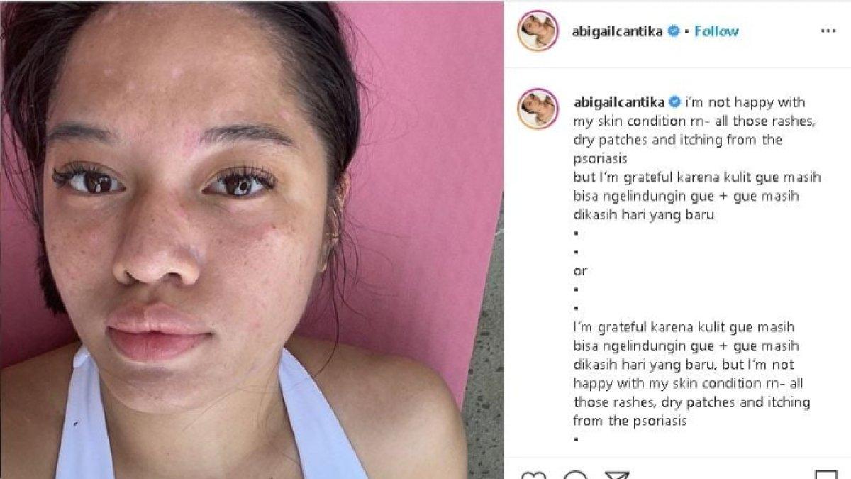 Cantika Abigail derita autoimun