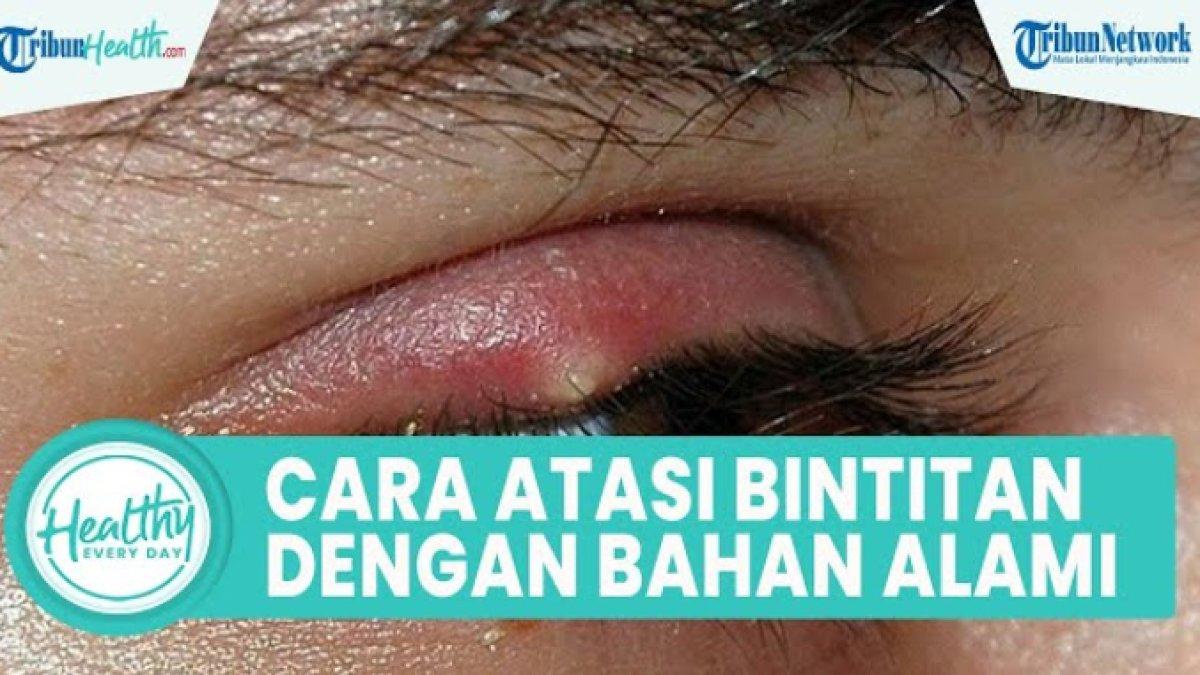 Cara alami obati mata bintitan