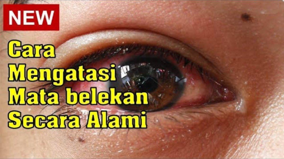 Cara mengatasi mata belekan
