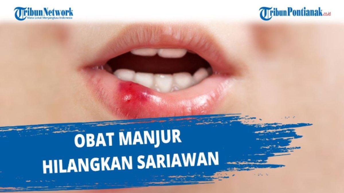 Cara obati sariawan