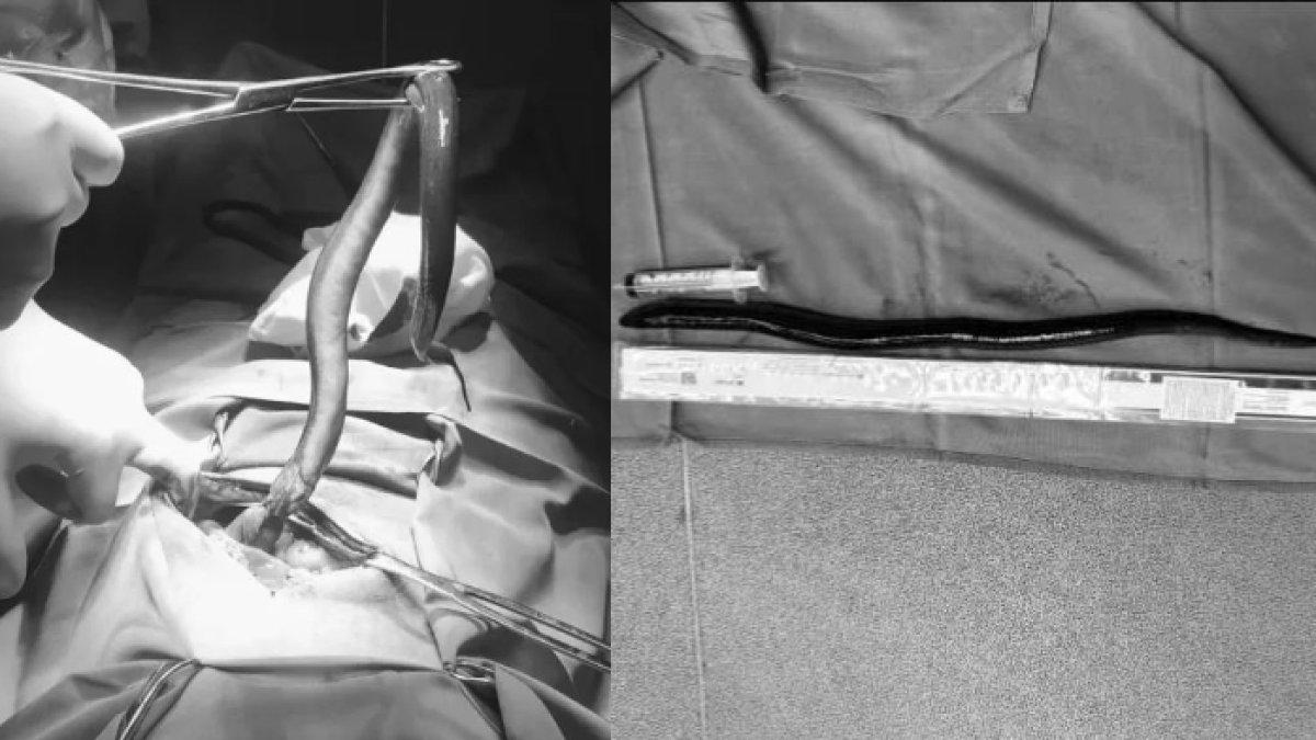 Dokter mengeluarkan belut hidup dari perut seorang pria di Vietnam.