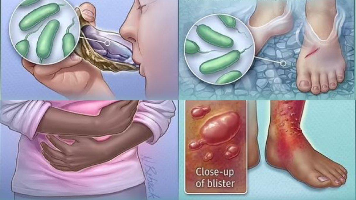 Setidaknya 12 orang Amerika telah meninggal karena infeksi Vibrio sepanjang tahun ini.