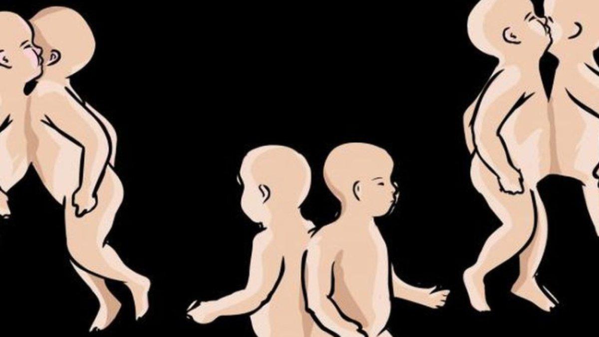 ILUSTRASI bayi kembar siam