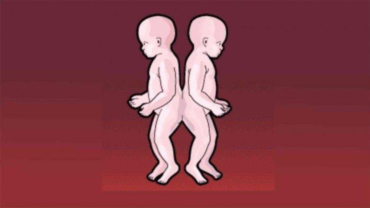 ILUSTRASI bayi kembar siam