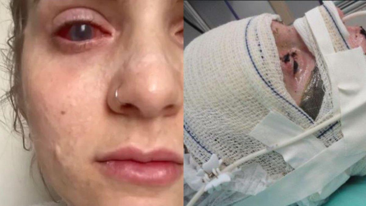 Jaqueline Gmack dari Papanduva, Brazil, dia awalnya mengonsumsi Ibuprofen untuk meredakan kram menstruasi.