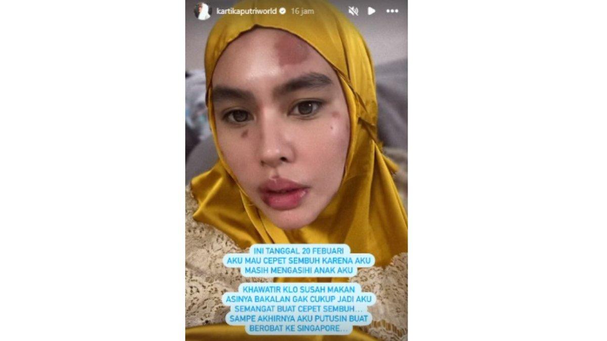 Kondisi Kartika Putri saat penyakit autoimun aktif.