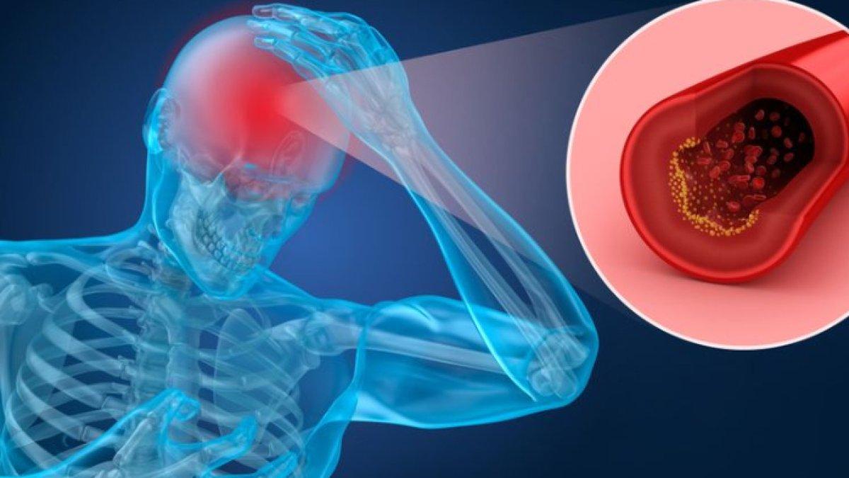 Langkah mengobati sekaligus mencegah penyakit stroke