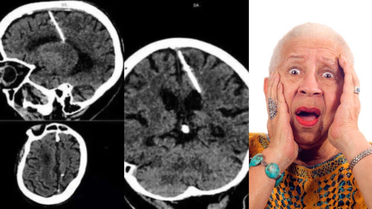Nenek terkejut ada jarum kecil nyangkut di otaknya, diperkirakan sudah 80 tahun terjebak, dokter syok: kok bisa