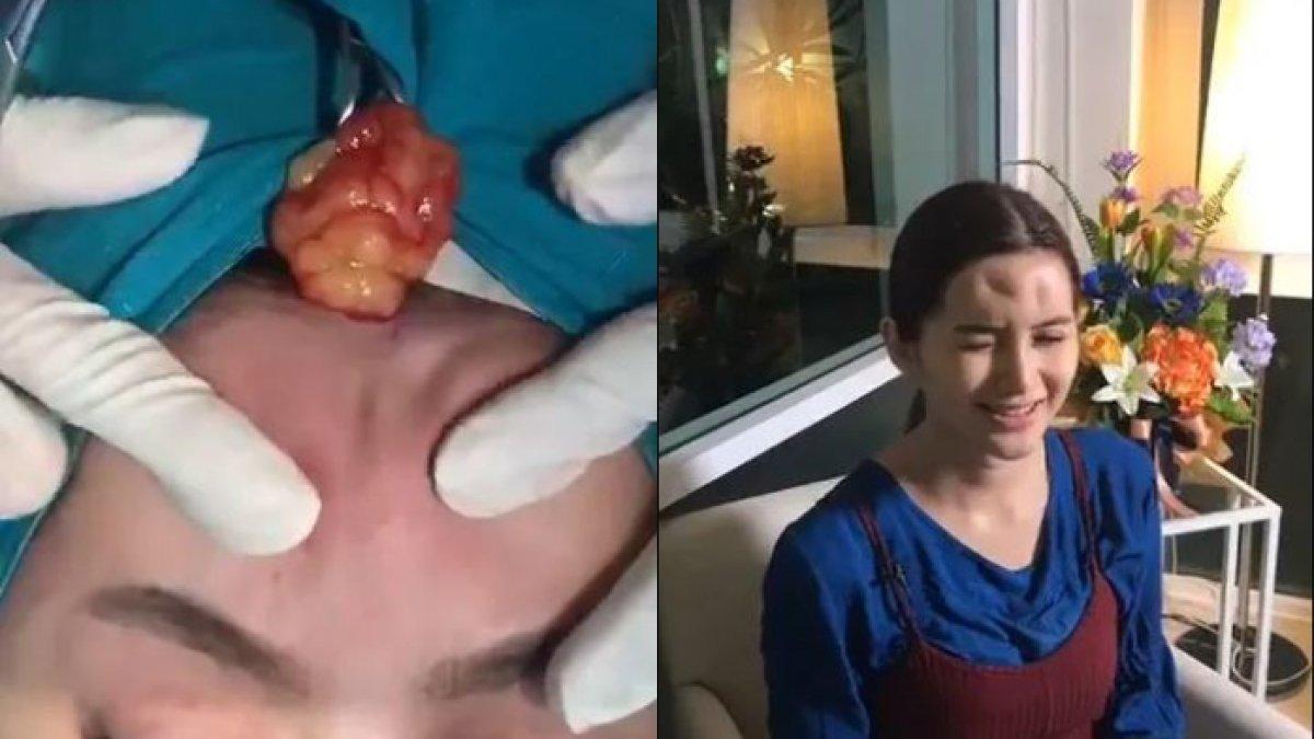 Nong Guang, 41 tahun, telah disuntik dengan filler hampir dua tahun yang lalu.